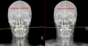 Folsom Chiropractor Says Atlas Orthogonal Treatment Means No More “Twisting and Cracking" Of Conventional Spinal Manipulation
